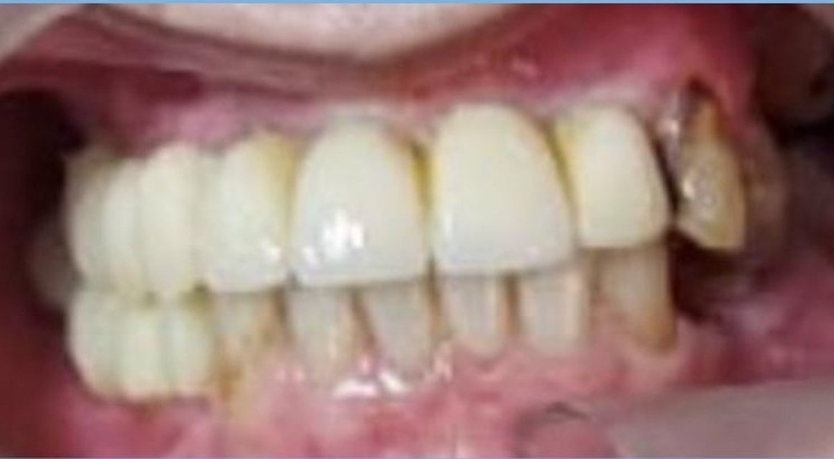 Caso de cirugía e implantes después del tratamiento