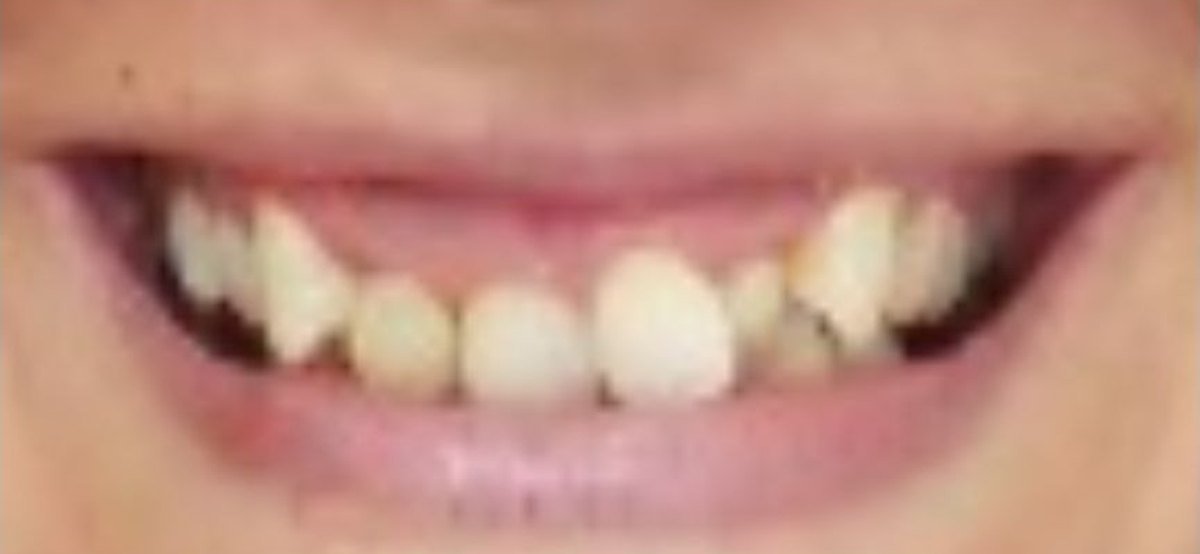 Caso de estética dental antes del tratamiento