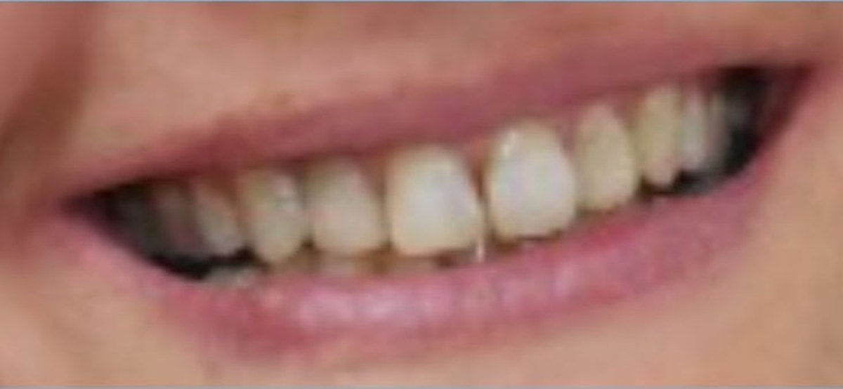 Caso de estética dental después del tratamiento
